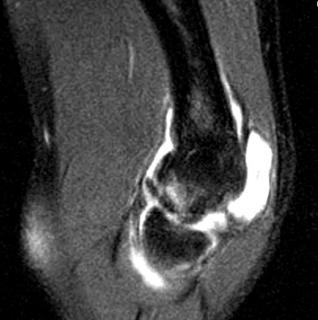 Fig. 134.11, A T2-weighted sagittal magnetic resonance imaging scan of a detached or semidetached osteochondritis dissecans lesion in a 12-year-old male adolescent.