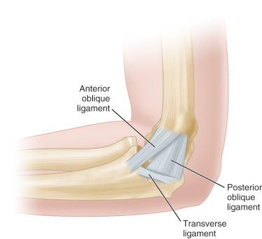 Fig. 134.3, The ulnar collateral ligament of the elbow consists of the anterior oblique bundle, the intermediate bundle, and the posterior oblique bundle.
