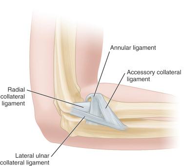 Fig. 134.4, The lateral collateral ligament complex of the elbow is demonstrated, including the lateral ulnar collateral ligament, the radial collateral ligament, and the accessory collateral ligament.