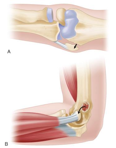 Fig. 134.10, (A and B) An avulsion fracture through the medial epicondyle, with attached ulnar collateral ligament and flexor/pronator mass.