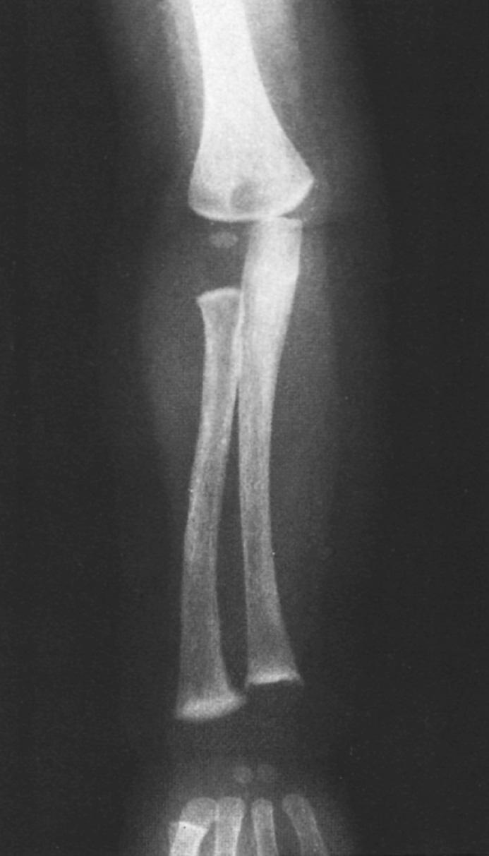 FIG 83.1, A 6-month-old infant was slow to roll over or attempt sitting. The diagnosis was rickets. This radiograph demonstrates the marked widening of the radiohumeral growth region.