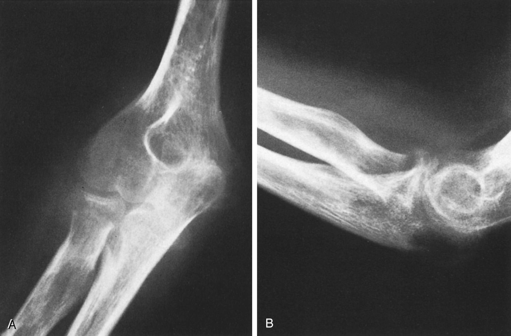 FIG 83.2, (A,B) Blurred trabecular pattern and mottled decrease in bone density typical of osteomalacia without distinguishing features at the elbow joint. The primary disease was renal tubular dysfunction.