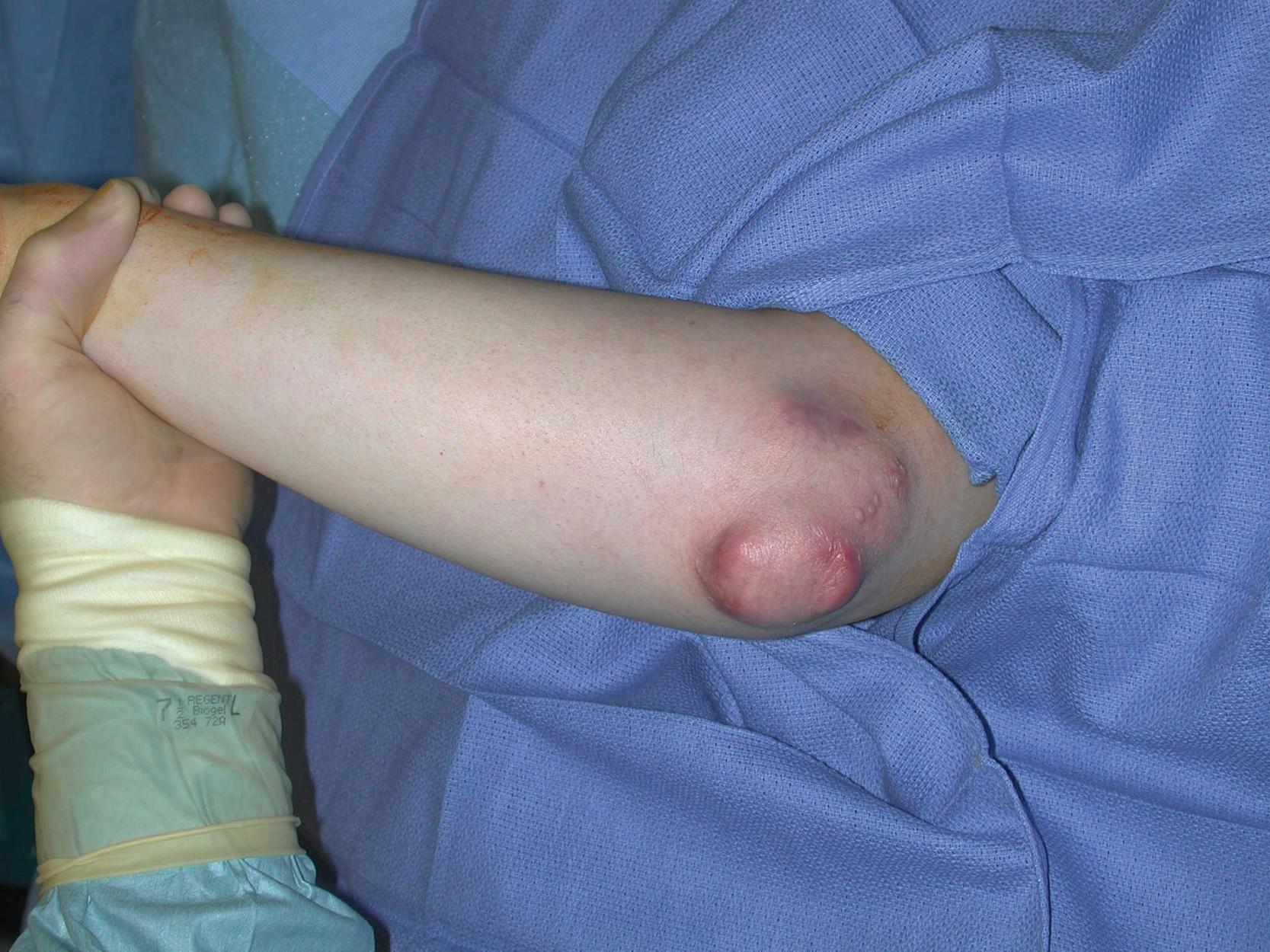 Fig. 17.1, A preoperative view showing multiple subcutaneous rheumatoid nodules in the left elbow.