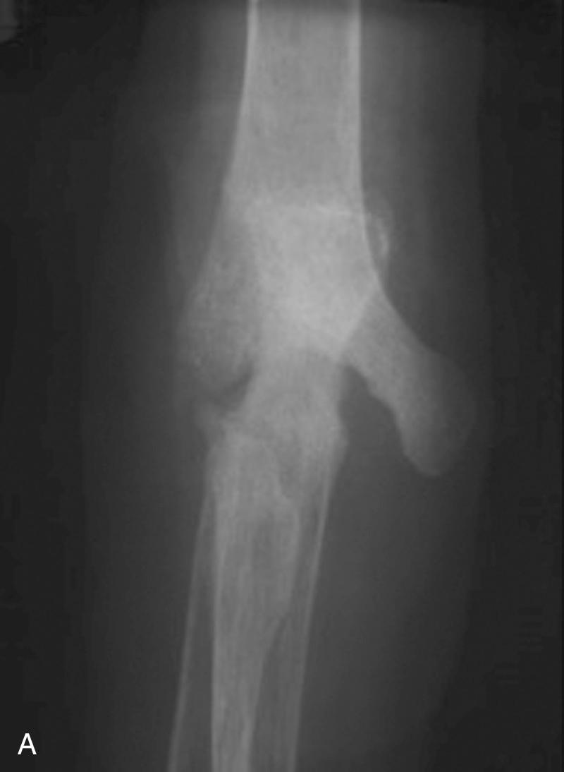 FIG 119.1, Anteroposterior (A) and lateral (B) radiographs after a stable resection arthroplasty with preservation of the humeral condyles and bony stability.