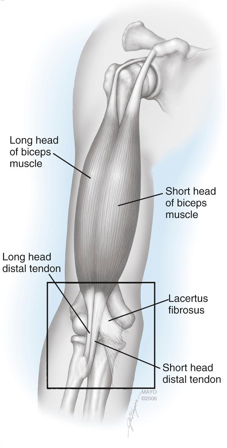 FIG 63.1, The biceps complex originates at the shoulder and inserts on the bicipital tuberosity of the radius. The long head of the biceps originates from the superior glenoid tubercle; the short head originates from the coracoid process. The biceps mechanism rotates 90 degrees externally from origin to insertion such that the short head part of the distal biceps tendon inserts distally and ulnarly on the bicipital tuberosity, and the long head portion inserts proximally and ulnarly.