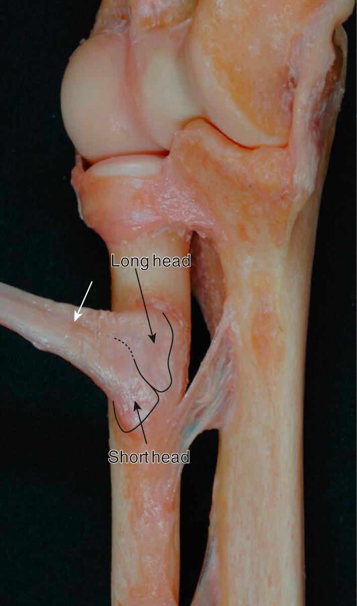 FIG 63.2, Dissection demonstrating the subtle distinction between the two tendons (white arrow) and the far ulnar attachment of the distal biceps tendon on the bicipital tuberosity. Note that the short head tendon attaches distally and the long head tendon attaches proximally.