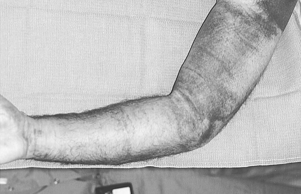 FIG 63.3, Ecchymosis is variably present. In this case, the patient was on aspirin and remained active after the injury.