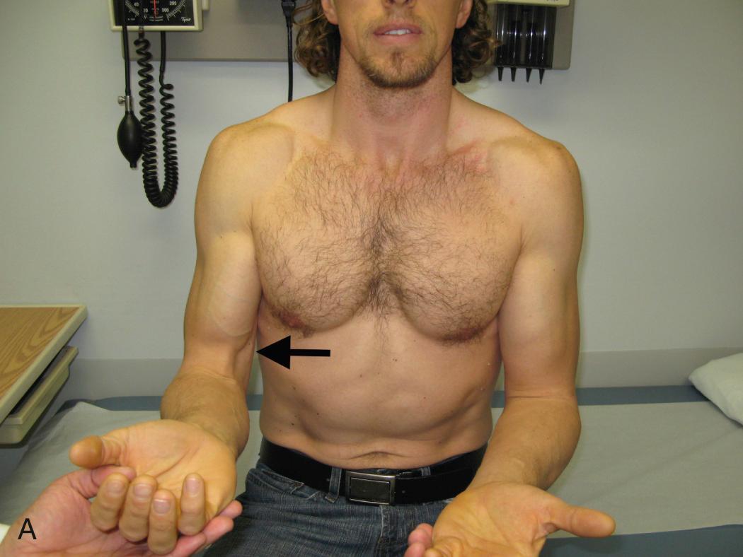 FIG 63.4, This active patient sustained an acute rupture of the left distal biceps tendon. On the right, note that with forearm supination (A), the biceps muscle normally rises or contracts proximally (black arrow) . However, on the injured left side, there is loss of definition without movement of the muscle belly. (B) With forearm pronation, the intact right muscle belly falls or slides distally, whereas the injured left side remains unchanged.