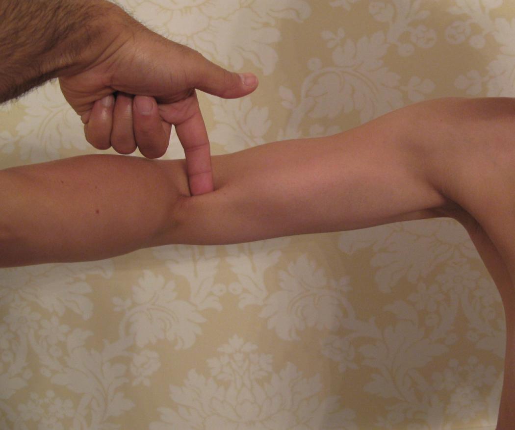 FIG 63.5, The hook test is based on palpation of the intact distal biceps tendon in the antecubital fossa. The test is performed with the patient actively abducting the shoulder to 90 degrees, elbow flexed to 90 degrees, and forearm in full supination. The examiner uses his or her index finger to hook the distal biceps tendon from lateral to medial across the antecubital fossa. The maneuver is conducted laterally to medially to avoid mistaking the intact lacertus as the biceps tendon.