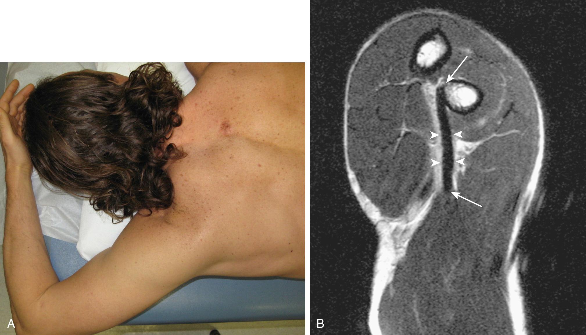 FIG 63.7, A distal biceps tendon–specific magnetic resonance imaging (MRI) view, termed the flexion, abduction, supination view, allows better visualization of the distal tendon. (A) The patient is positioned in the MRI scanner prone, with the arm abducted overhead, elbow flexed, and forearm supinated. (B) This view allows complete visualization of the distal biceps tendon, from the musculotendinous junction to the insertion on the bicipital tuberosity.