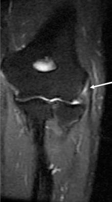 Fig. 61.4, Typical findings on magnetic resonance imaging with signal change in the extensor tendon origin.