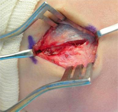 Fig. 61.5, Open surgical débridement for epicondylitis (the Nirschl procedure).