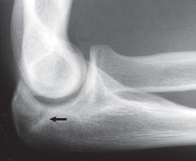 Fig. 64.11, A plain lateral radiograph of the elbow in an overhead throwing athlete with posterior elbow pain. The arrow indicates lucency through the proximal olecranon, consistent with a stress fracture. Typically these types of injury cause pain with rapid extension of the elbow, as seen in throwers. Also, pain on palpation of the stress fracture site is typically present.