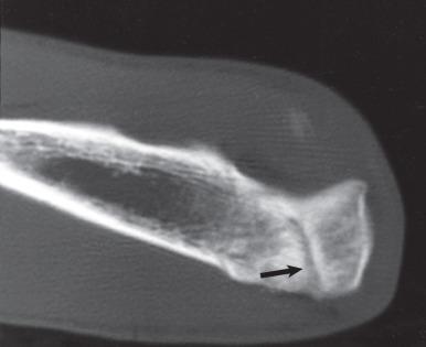 Fig. 64.12, A computed tomography scan of the same elbow depicted in Fig. 64.11 . This scan demonstrates the olecranon stress fracture in this thrower (arrow) .