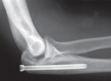 Fig. 64.13, After failure of conservative management, a percutaneous cannulated screw was placed.