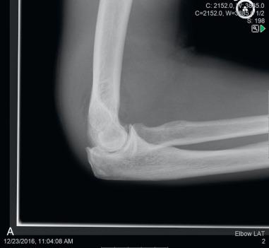 Fig. 64.19, Radiographs showing a posterior olecranon osteophyte before (A) and after (B) excision.