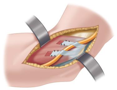 Fig. 64.14, Anterior subcutaneous transposition of the ulnar nerve.