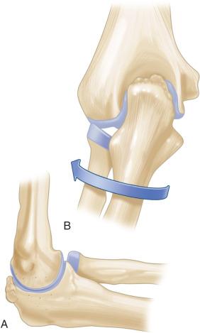 Fig. 64.5, Valgus extension overload (A) and an illustration of force (B), showing pathomechanics.