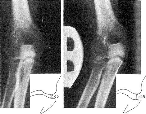 Fig. 64.6, Plain radiograph and schematic (left) of the elbow compared with a stress radiograph (right) ; note the widening of the medial joint space showing laxity/incompetence of the ulnar collateral ligament.