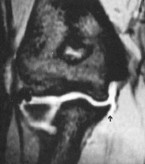 Fig. 64.7, Magnetic resonance arthrogram of an elbow showing a complete distal tear of the ulnar collateral ligament.