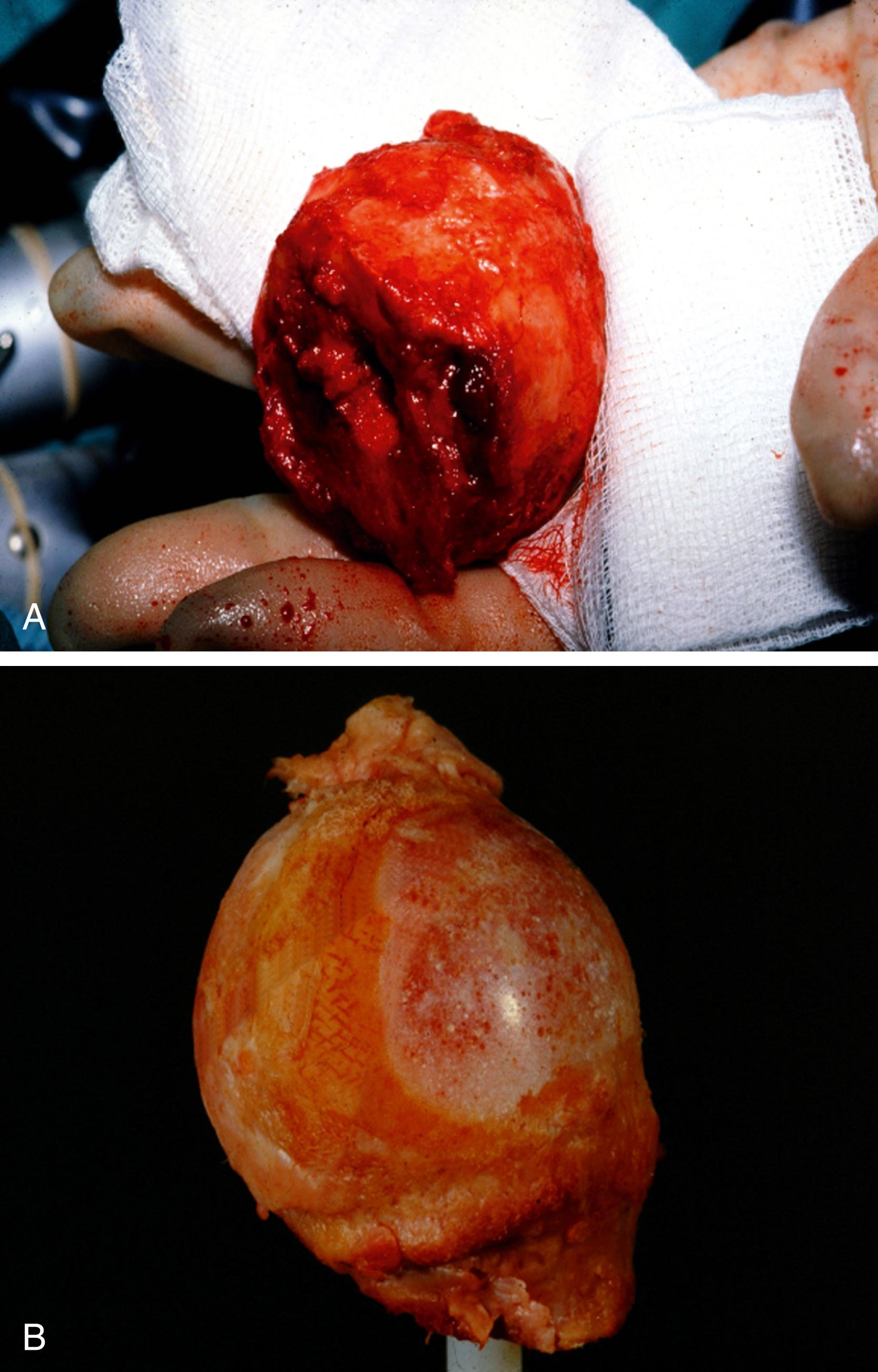Fig. 11.3, Femoral Heads Removed at Operation.