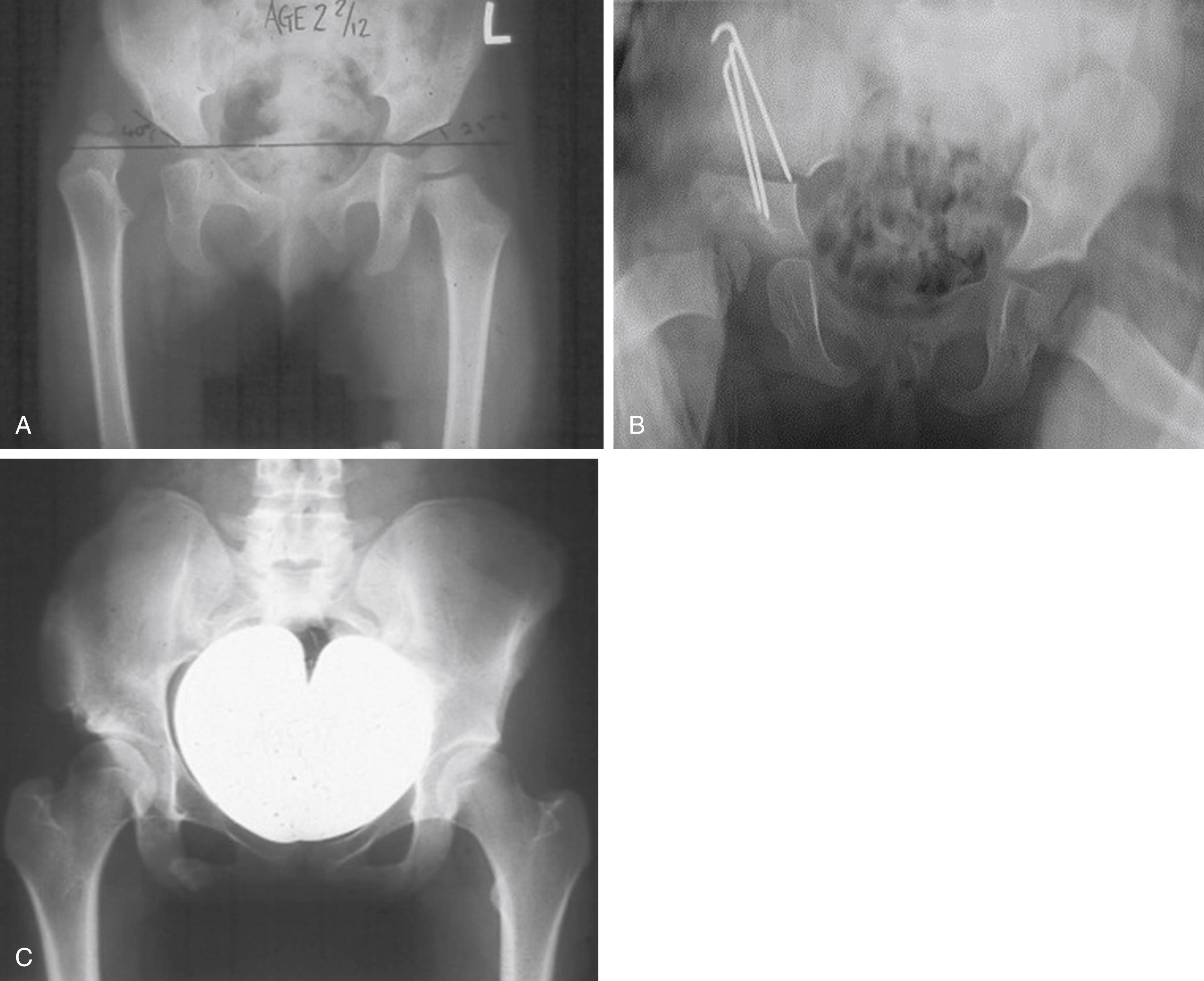 Fig. 11.4, X-rays of patient with late presenting hip dysplasia (A) , who went on to have an open reduction and pelvic (Salter) osteotomy (B) , and 25 years later (C) . The wing of the ilium supplied a bone graft.