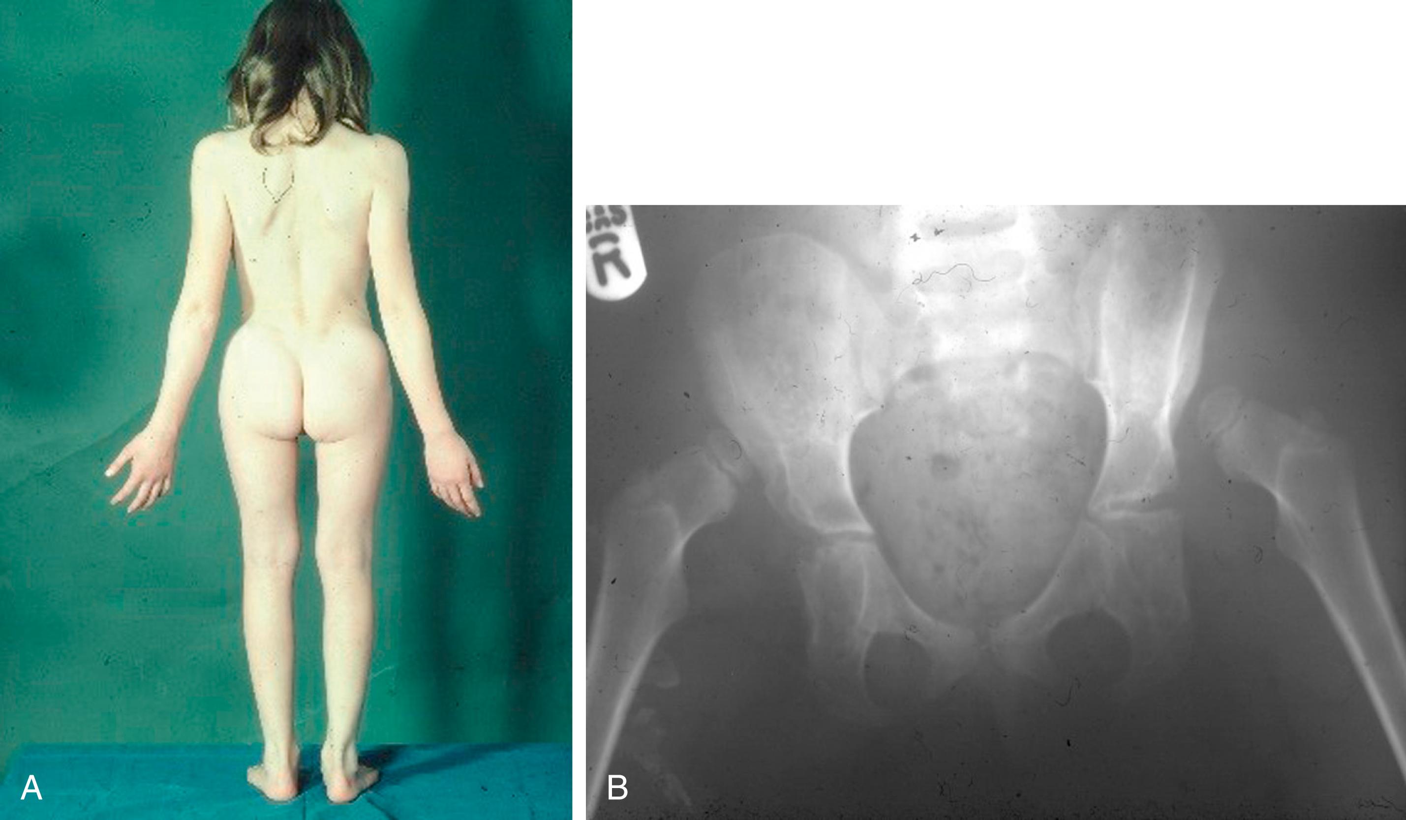 Fig. 11.5, A 7-year-old who had just presented with bilateral development dysplasia of the hip (DDH). (A) Note that the photograph was taken from behind and shows a lumbar lordosis. (B) The x-ray shows bilateral high DDH with bilateral dysplastic acetabulae.