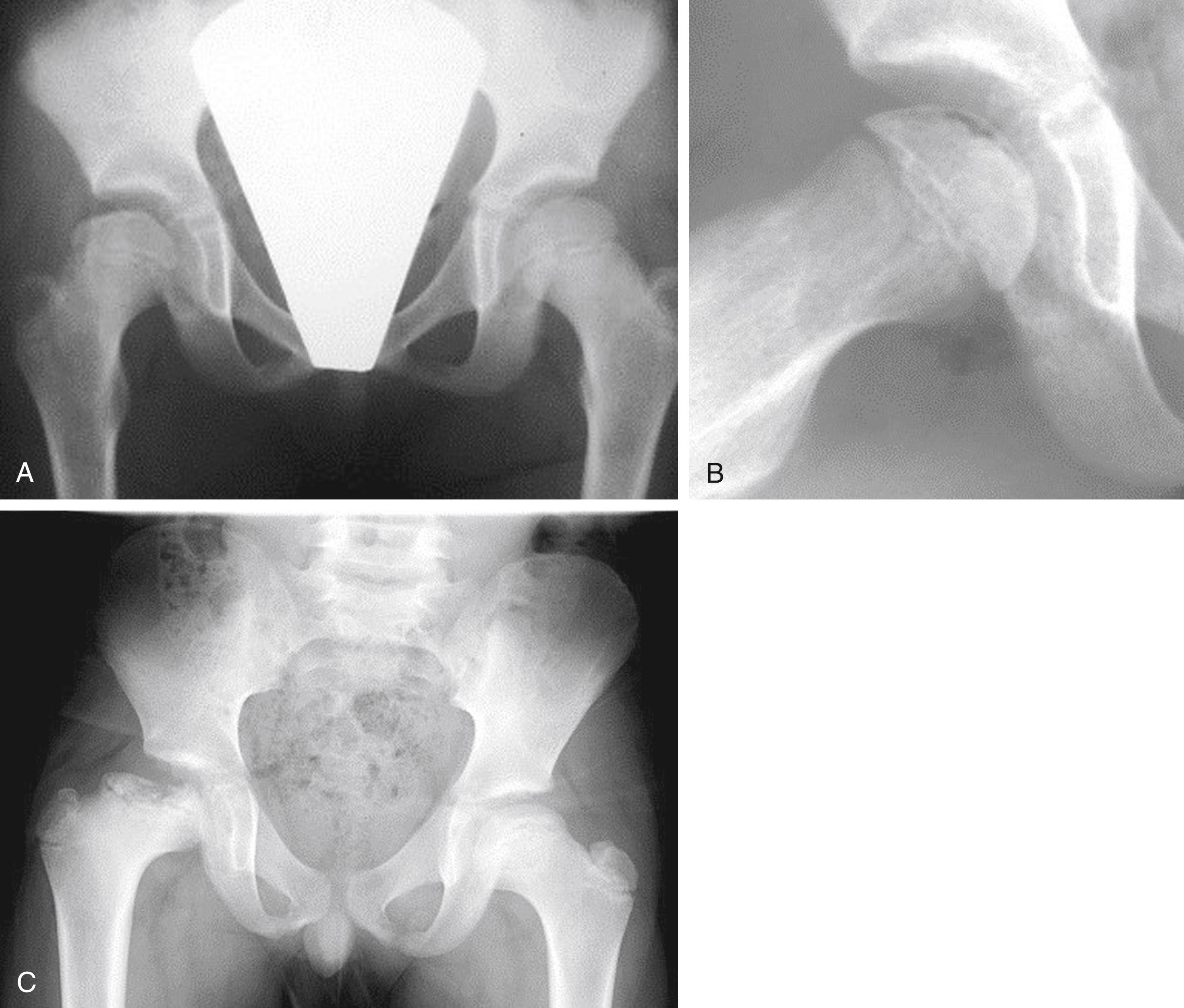 Fig. 11.6, Perthes Disease.