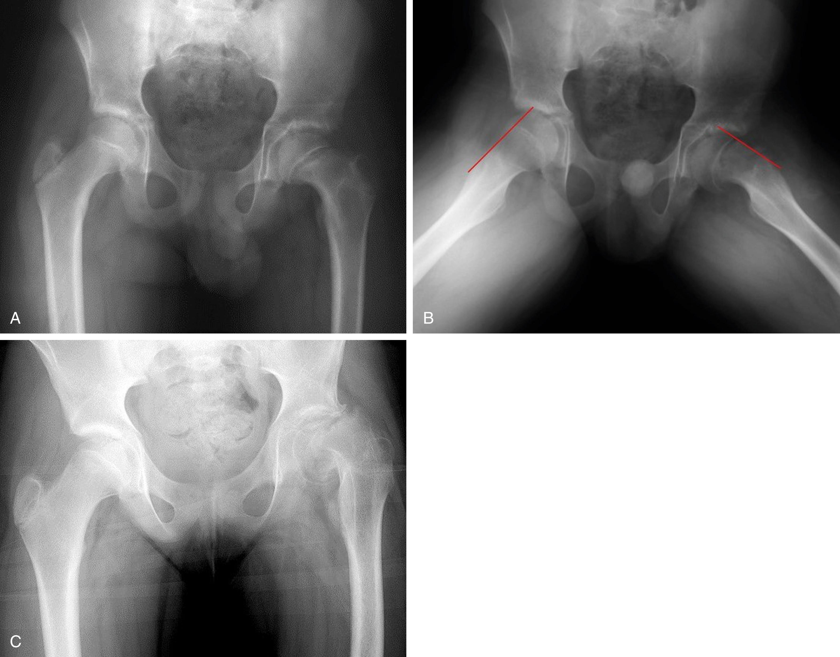 Fig. 11.7, Examples of Slipped Upper Femoral Epiphysis.