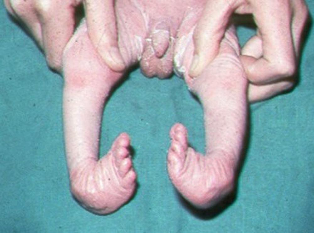 Fig. 11.8, Neonatal Club Feet.