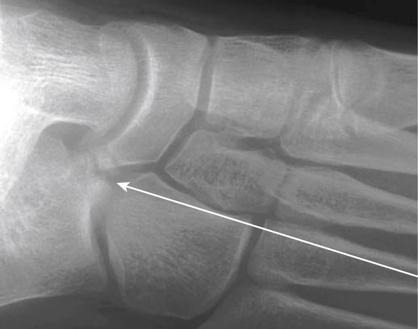 Fig. 11.9, X-Ray Showing Tarsal Coalition.