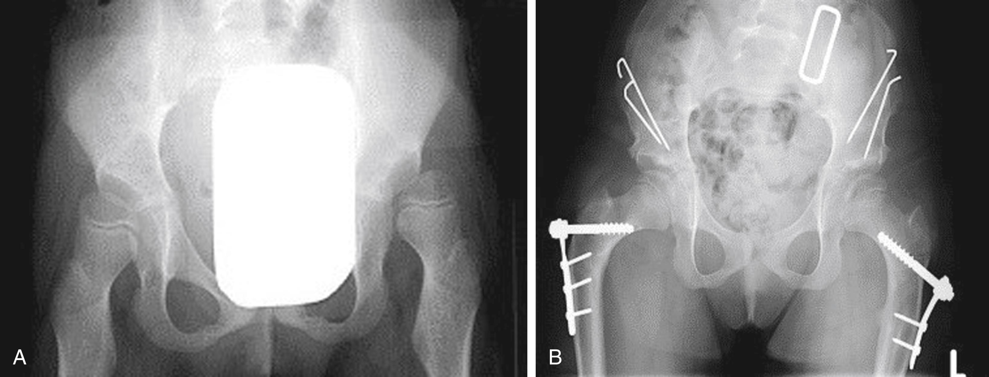 Fig. 11.10, Bilateral subluxing hips in a patient with severe total body cerebral palsy (A) treated with realignment osteotomies of upper femurs and both acetabula (B) .