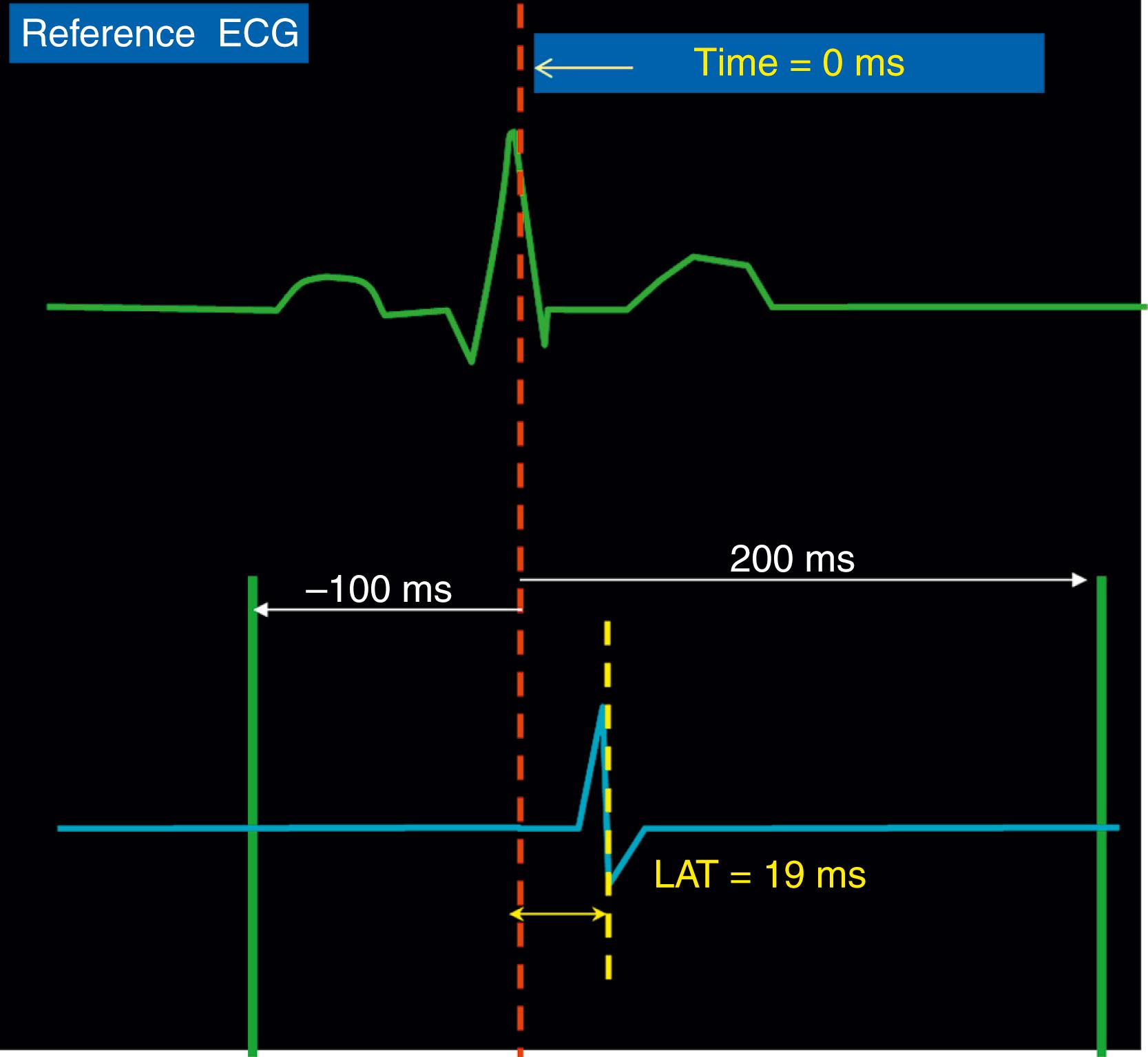 Fig. 128.2, Electrogram annotation.