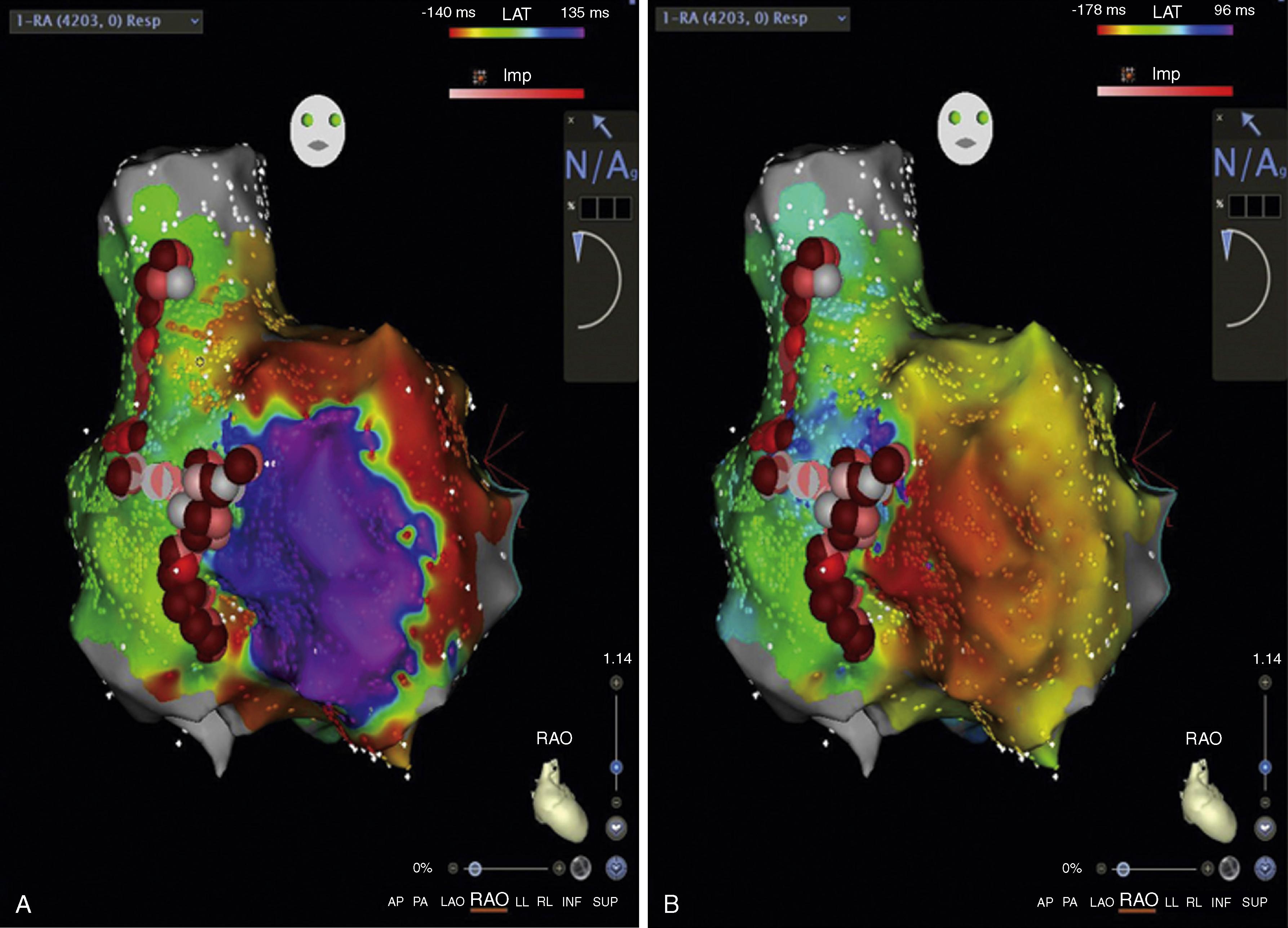 Fig. 128.3, Three-dimensional electroanatomic activation map of an atrial flutter wave propagating across the right atrium.