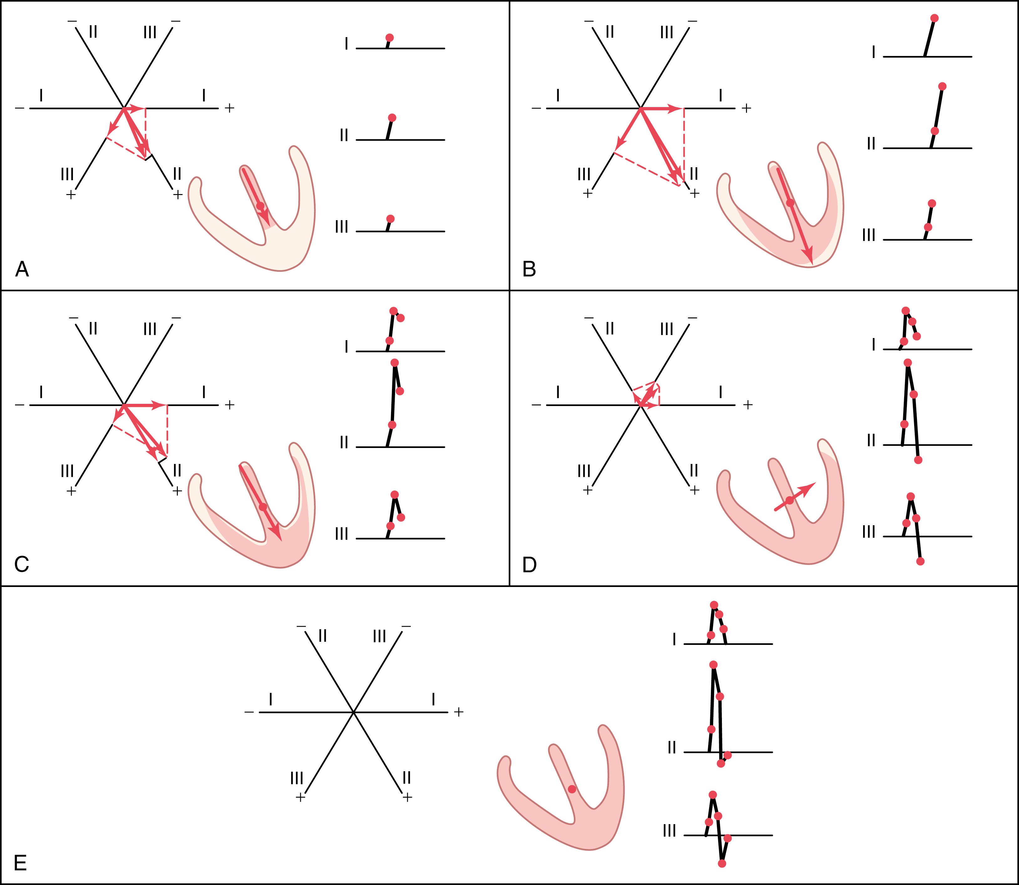 Figure 12-7, Shaded areas of the ventricles are depolarized (−); nonshaded areas are still polarized (+). Shown are the ventricular vectors and QRS complexes 0.01 second after onset of ventricular depolarization (A), 0.02 second after onset of depolarization (B), 0.035 second after onset of depolarization (C), 0.05 second after onset of depolarization (D), and after depolarization of the ventricles is complete, 0.06 second after onset (E).