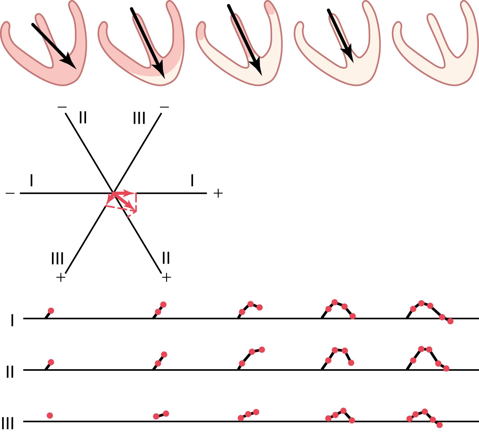 Figure 12-8, Generation of the T wave during repolarization of the ventricles, also showing vectorial analysis of the first stage of repolarization. The total time from the beginning of the T wave to its end is approximately 0.15 second.