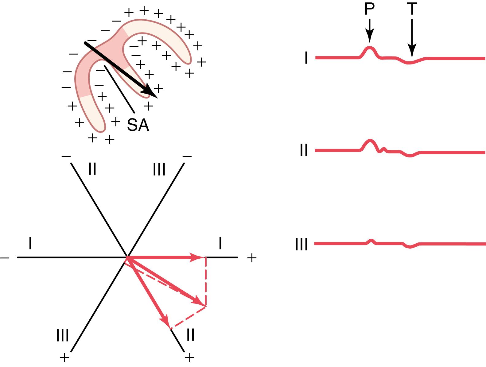 Figure 12-9, Depolarization of the atria and generation of the P wave showing the maximum vector through the atria and the resultant vectors in the three standard leads. At the right are the atrial P and T waves. SA, Sinoatrial node.