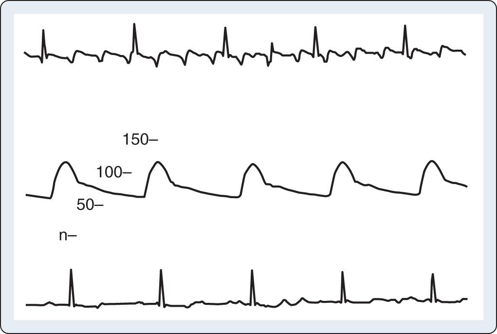 Fig. 9.2, (Top) Baseline artifact simulates atrial flutter in a cannulated patient. (Middle) This patient had stable arterial pressure just before institution of full cardiopulmonary bypass, similar to that described by Kleinman and associates. (Bottom) The “pseudo-flutter waves” are corrected by application of the grounding cable.