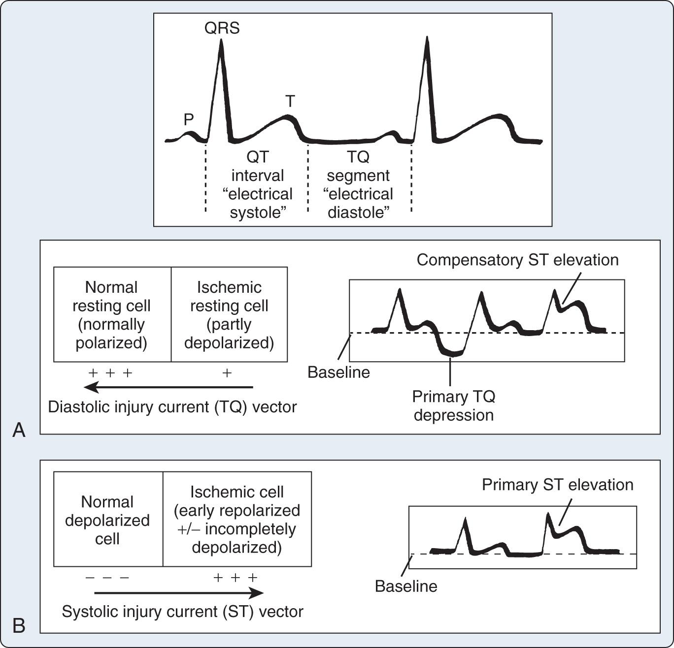 Fig. 9.3, Pathophysiology of ischemic ST-segment elevation. Two basic mechanisms have been advanced to explain the elevation seen with acute myocardial injury. (A) Diastolic current of injury. In this case (first QRS-T complex), the ST-segment vector is directed away from the relatively negative, partly depolarized, ischemic region during electrical diastole (TQ interval), and the result is primary TQ-interval depression. Conventional alternating current electrocardiograms compensate for the baseline shift, and an apparent ST-segment elevation (second QRS-T complex) results. (B) Systolic current of injury. In this case, the ischemic zone is relatively positive during electrical systole because the cells are repolarized early and the amplitude and upstroke velocity of their action potentials may be decreased. This injury current vector is oriented toward the electropositive zone, and the result is primary ST-segment elevation.