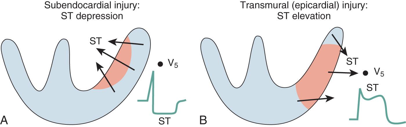 Fig. 9.4, Current of injury patterns with acute ischemia. (A) With predominant subendocardial ischemia the resultant ST-segment vector is directed toward the inner layer of the affected ventricle and the ventricular cavity. Overlying leads therefore record ST-segment depression. (B) With ischemia involving the outer ventricular layer (transmural or epicardial injury), the ST-segment vector is directed outward. Overlying leads record ST-segment elevation. Reciprocal ST-segment depression can appear in contralateral leads.