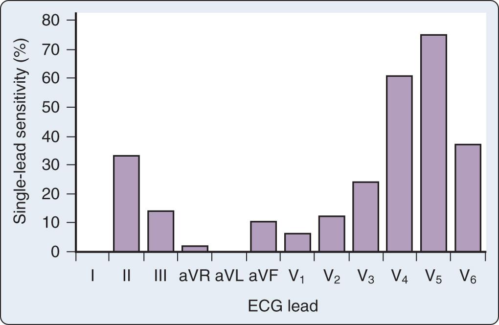 Fig. 9.5, Single-lead sensitivity for the intraoperative detection of ischemia based on 51 episodes detected in 25 patients undergoing noncardiac surgical procedures. Sensitivity was calculated by dividing the number of episodes detected in that electrocardiographic (ECG) lead by the total number of episodes. Sensitivity was greatest in lead V5, and the lateral leads (I, aVL) were insensitive.