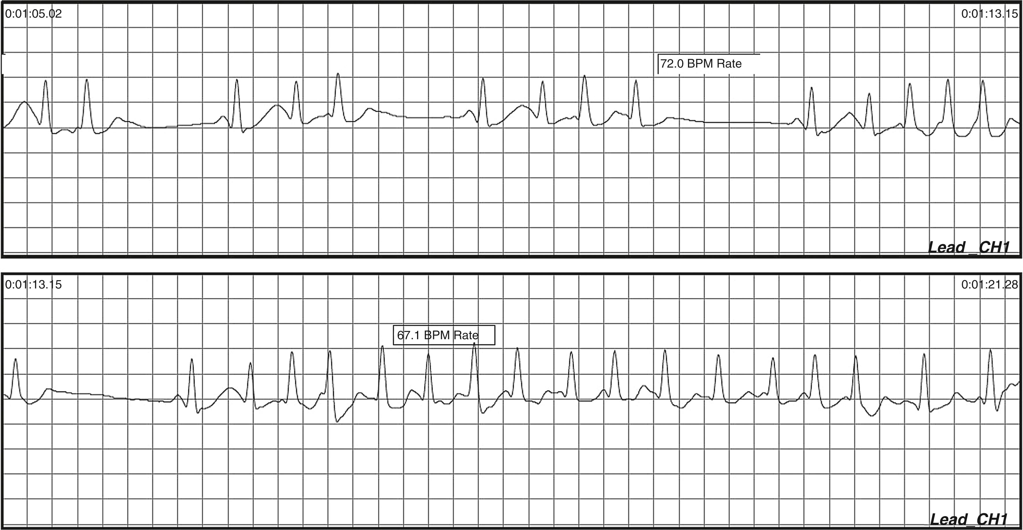 Fig. 62.1, Ambulatory recording during palpitations and presyncope.