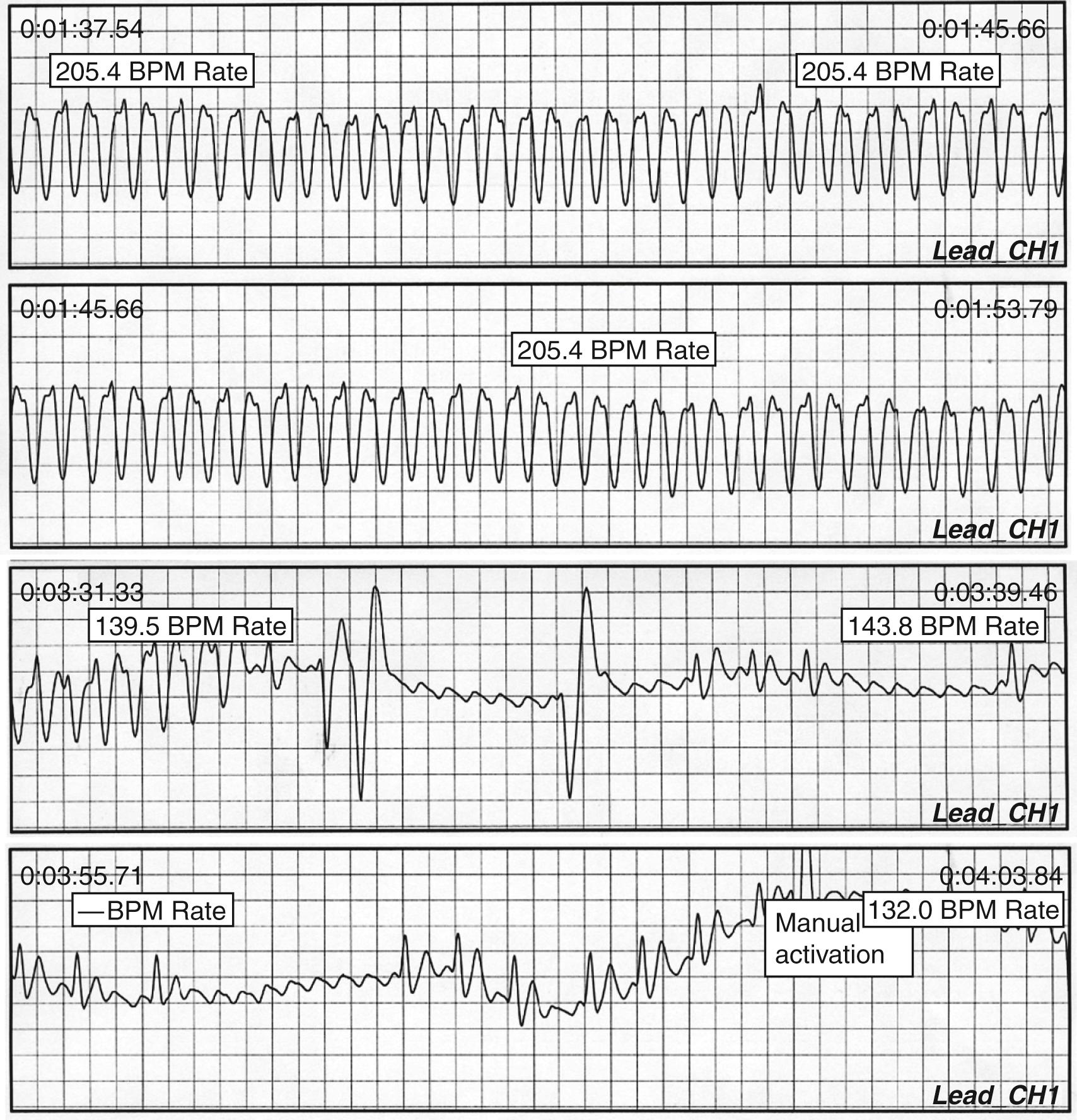 Fig. 62.2, External loop recording download from a patient with near syncope with palpitations.