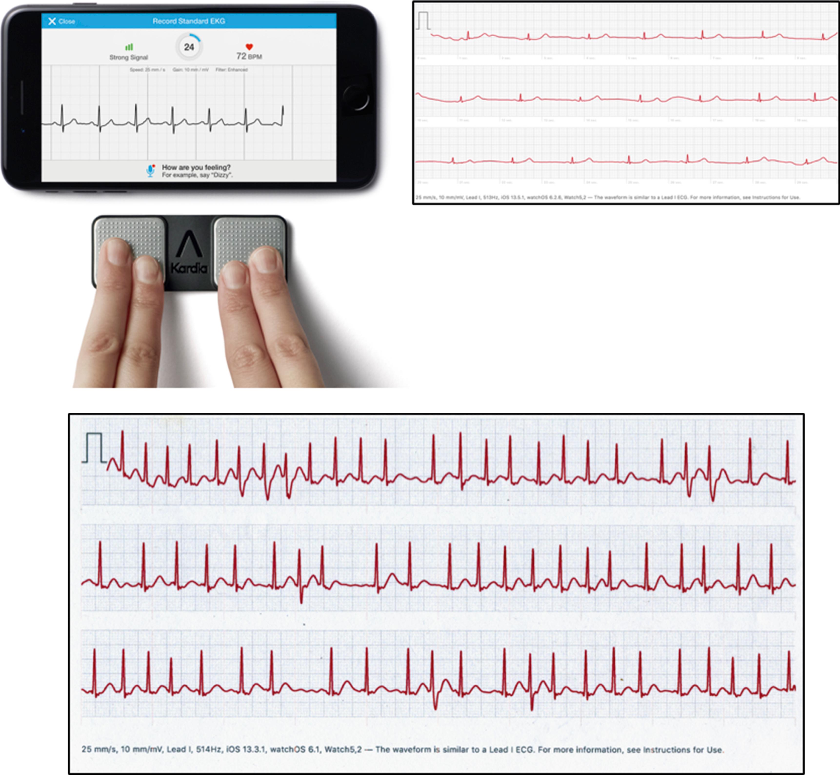 Fig. 62.3, Sample direct-to-consumer medical electrocardiogram recording device (Alive Cor, Kardia) and recorded rhythm strips from two patients: one with fatigue and sinus bradycardia, and a second with palpitations and apparent atrial fibrillation.