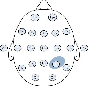 Figure 4-3, The discharge depicted here is highly focal and is only detected by a single electrode (P4). The adjacent electrodes are electrically “quiet.” This highly focal pattern is relatively uncommon; most focal discharges affect multiple electrodes at once. When an event is limited to a single electrode, the possibility of an electrode artifact should be considered.
