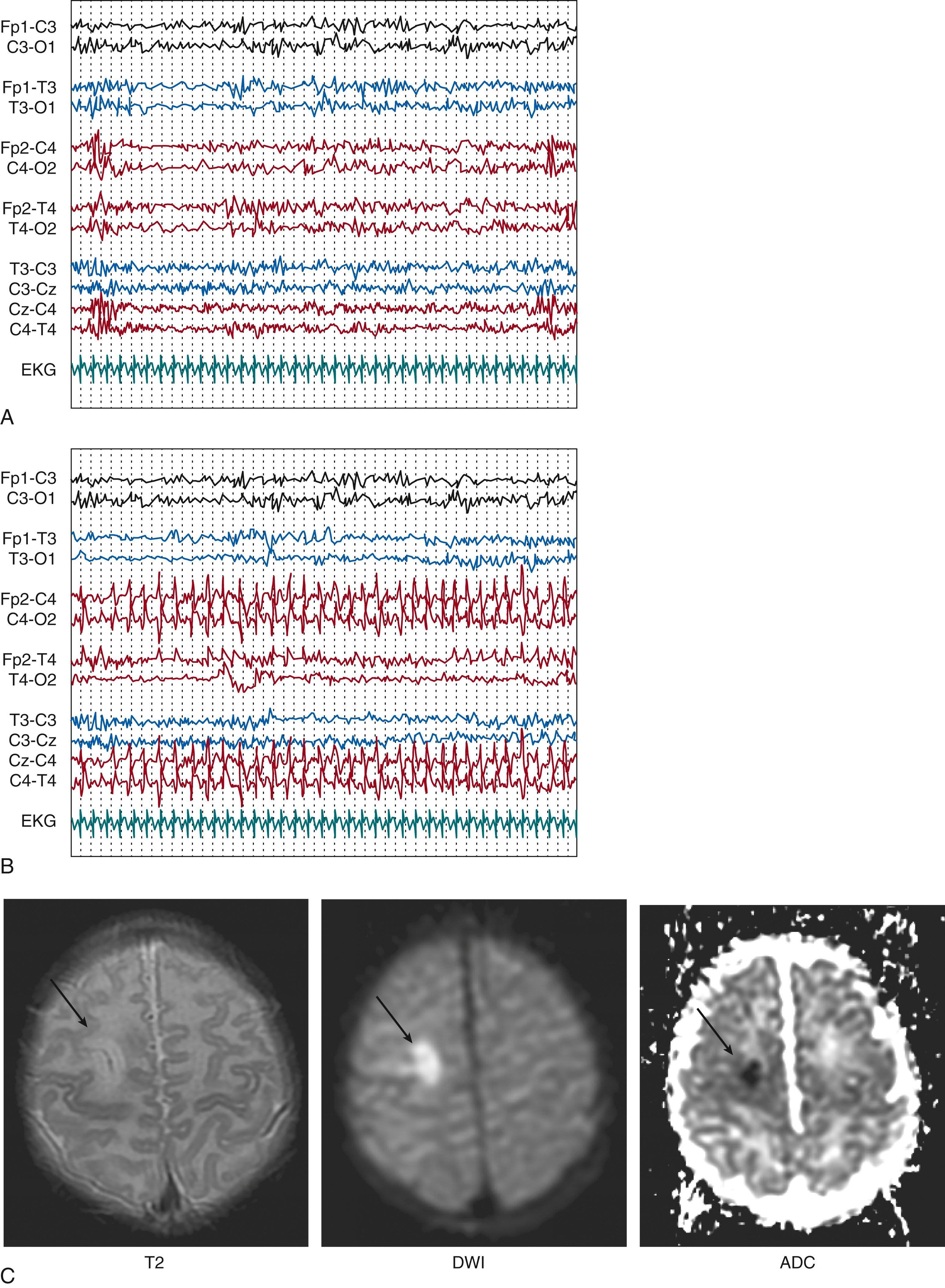 Fig. 130.2, One-day-old term neonate presenting with prolonged focal clonic jerking of the left arm. (A) Interictal spikes are seen over the right central region over a normal background. (B) Ictal discharge characterized by rhythmic spikes followed by slow waves with the spikes being time-locked with the clonic jerks. Gain, 10 μV/mm; high frequency filter, 70 Hz; paper speed, 15 mm/s. (C) MRI showing a focal ischemic stroke on the right central region concordant with the location of the interictal and ictal discharges on electroencephalography. ADC , Apparent diffusion coefficient; DWI , diffusion-weighted imaging.