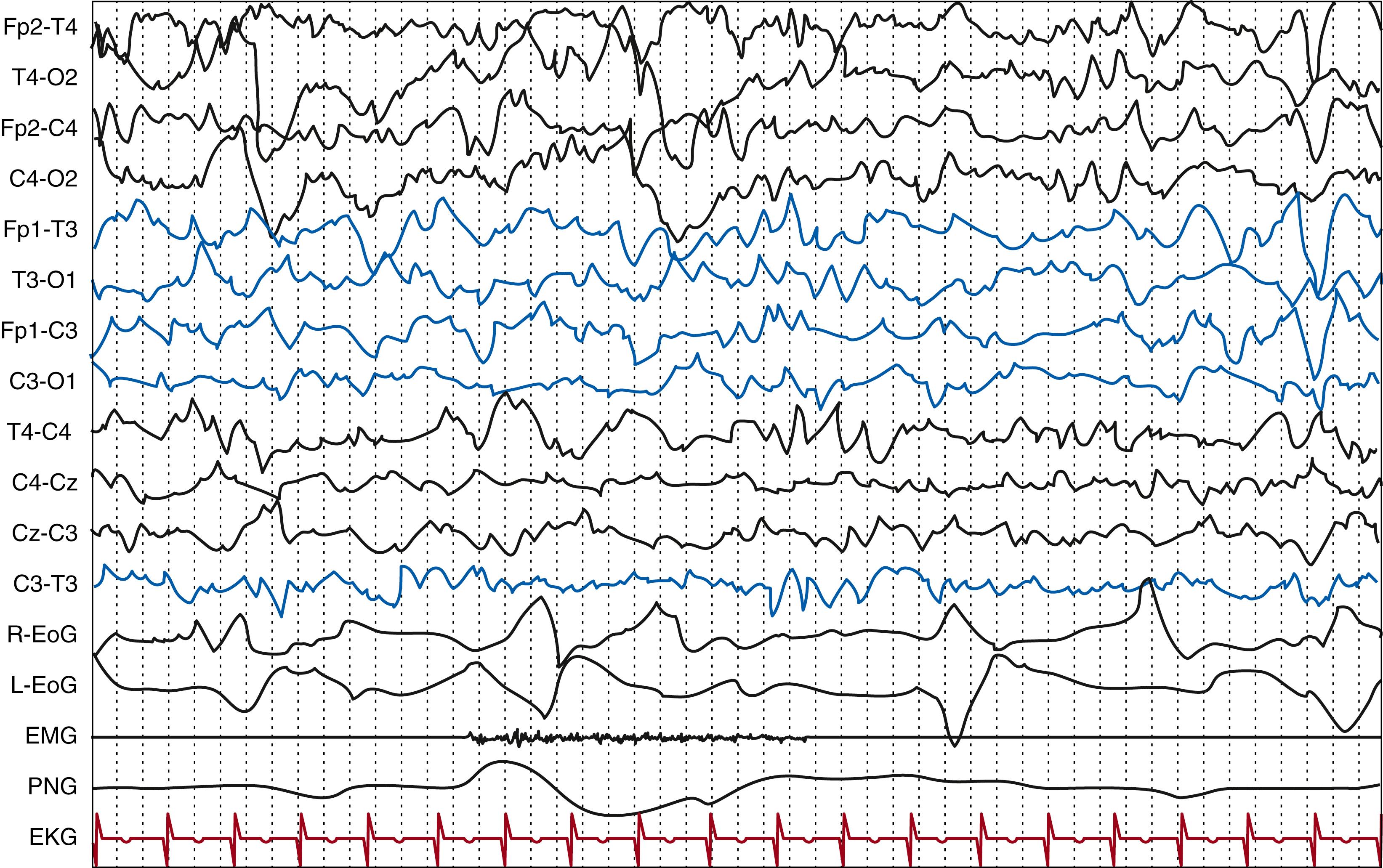 Fig. 130.3, Healthy term newborn. Quiet wakefulness. Delta-theta medium-to-high voltage continuous background activity with intermixed low voltage fast rhythms (activité moyenne) . Note the presence of ocular movements, muscular activity, and irregularity of the respiratory pattern. Polygraphic video-electroencephalography (EEG, EOG: electro-oculogram, EMG: right deltoid, PNG: pneumogram, EKG). Gain, 7 μV/mm; high-frequency filter, 70 Hz; paper speed, 10 mm/s.