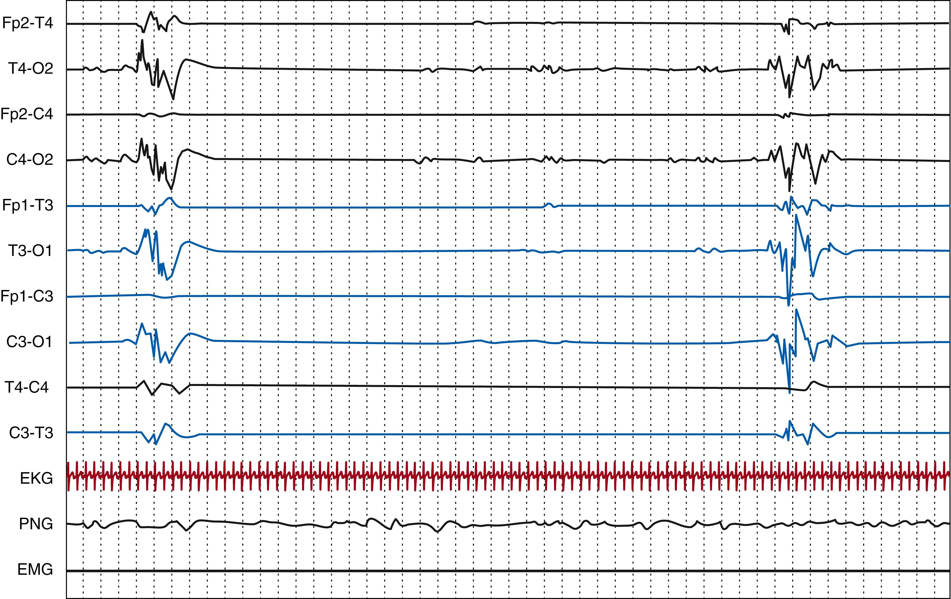 Fig. 130.4, Polygraphic electroencephalography tracing recorded at 1 week of age (25 weeks postmenstrual age) in a preterm neonate born at 24 weeks. Discontinuous tracing. Delta bursts of 3 seconds duration, intermixed with interburst interval of 25 seconds (EEG, EKG, PNG: pneumogram, EMG: right deltoid). Gain, 15 μV/mm; high frequency filter, 70 Hz; paper speed, 120 mm/s.