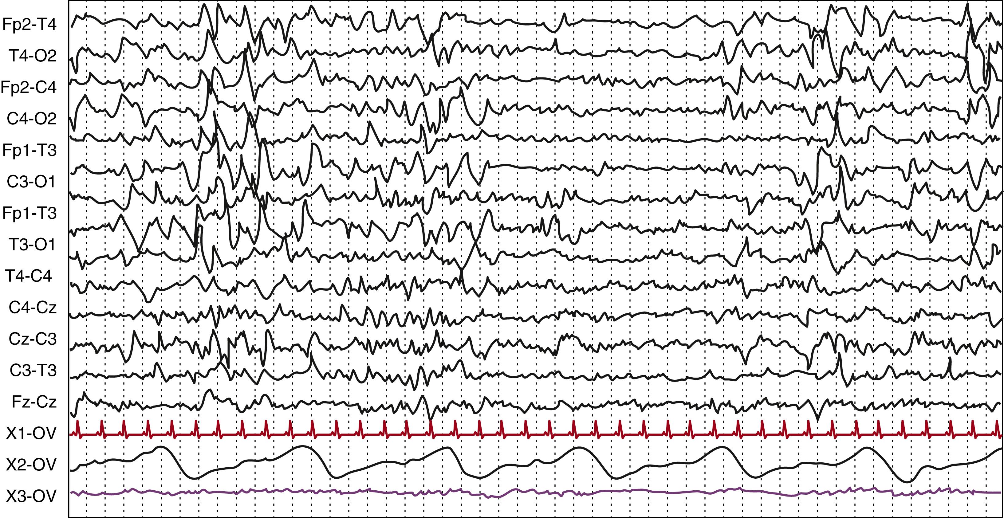 Fig. 130.5, Ten-day-old term newborn. Pattern of tracé alternant during quiet sleep characterized by bilateral synchronous and symmetrical bursts of delta waves of high amplitude alternating with theta activity of lower amplitude. Gain, 10 μV/mm; high frequency filter, 70 Hz; paper speed, 15 mm/s.