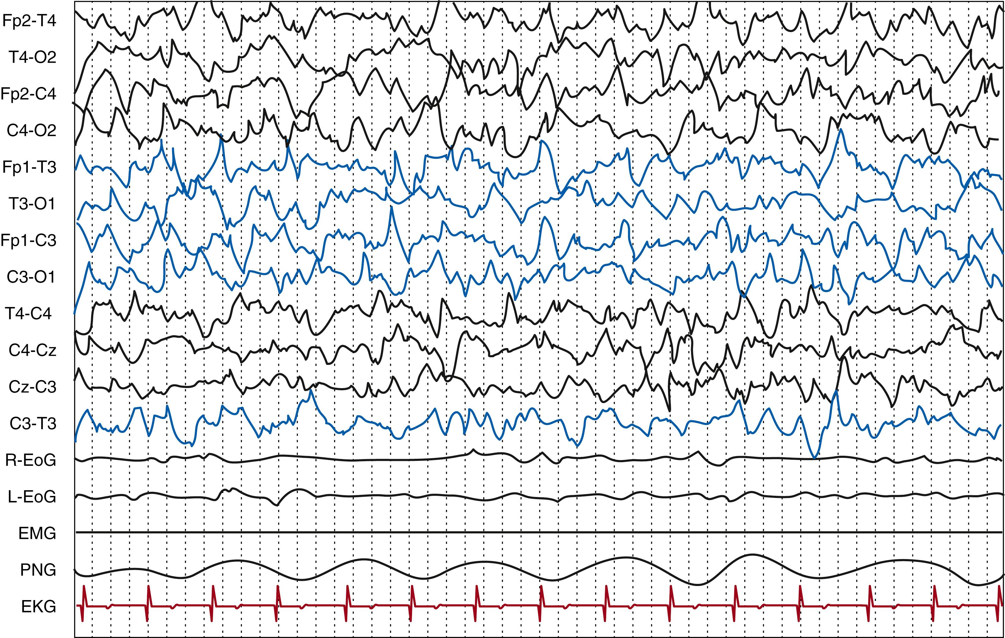 Fig. 130.6, Term newborn. Quiet sleep, high-voltage slow pattern, characterized by continuous delta activity of high-medium voltage. Behavioral state is confirmed by the regularity of the respiratory pattern and the absence of rapid ocular movements. Polygraphic video-electroencephalography (R-EoG: right electro-oculogram, L-EoG: left electro-oculogram, EMG, PNG: pneumogram, EKG). Gain, 7 μV/mm; high frequency filter, 70 Hz; paper speed, 30 mm/s.